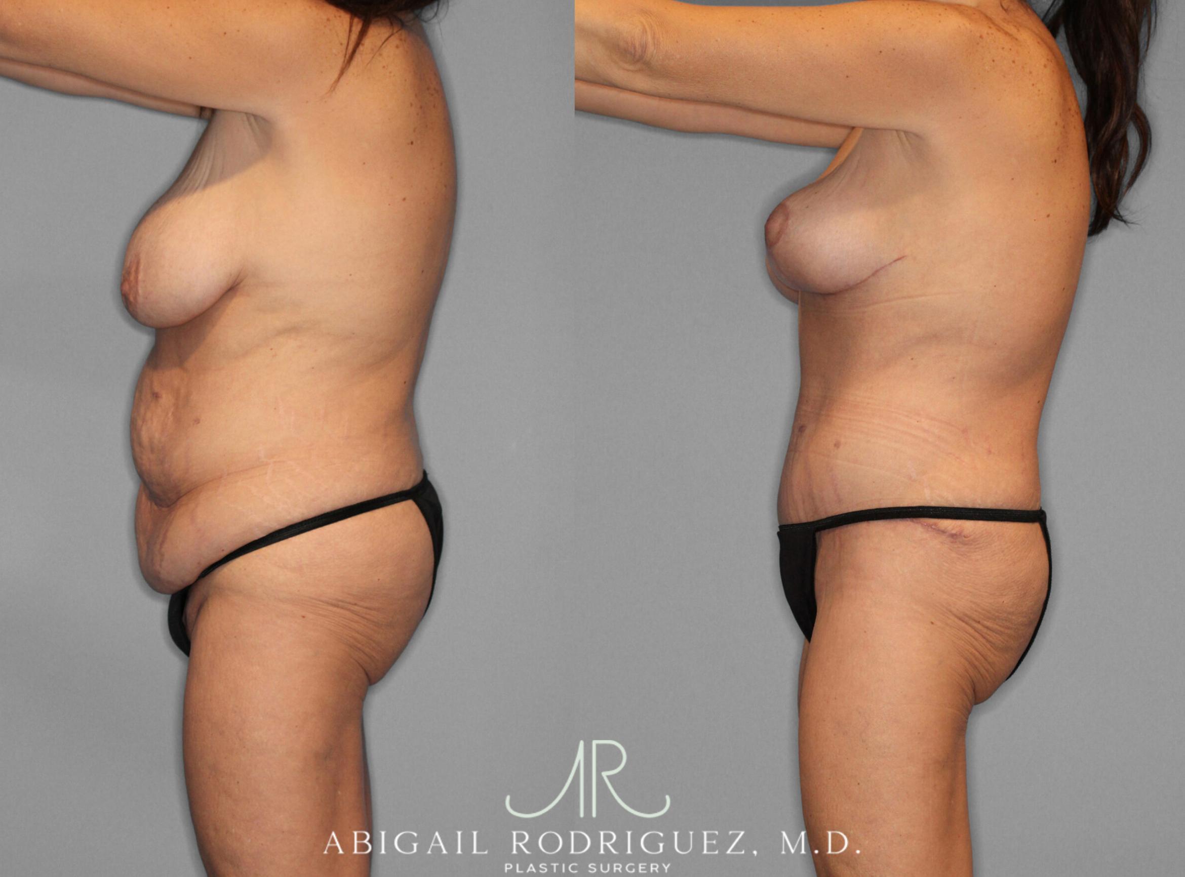 Before & After Mommy Makeover Case 254025 View 2 View in Houston, TX