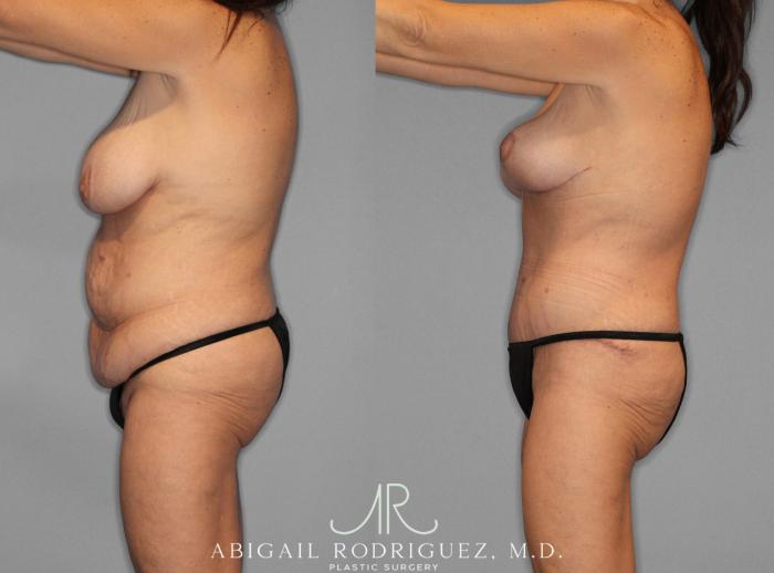 Before & After Mommy Makeover Case 254025 View 2 View in Houston, TX