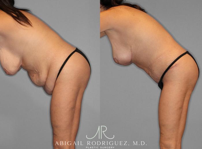 Before & After Mommy Makeover Case 254025 View 3 View in Houston, TX