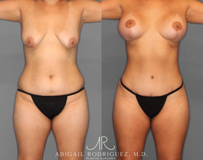 Before & After Mommy Makeover Case 254151 View 1 View in Houston, TX