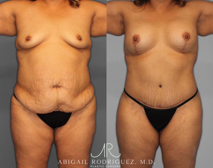 Before & After Mommy Makeover Case 254519 View 1 View in Houston, TX