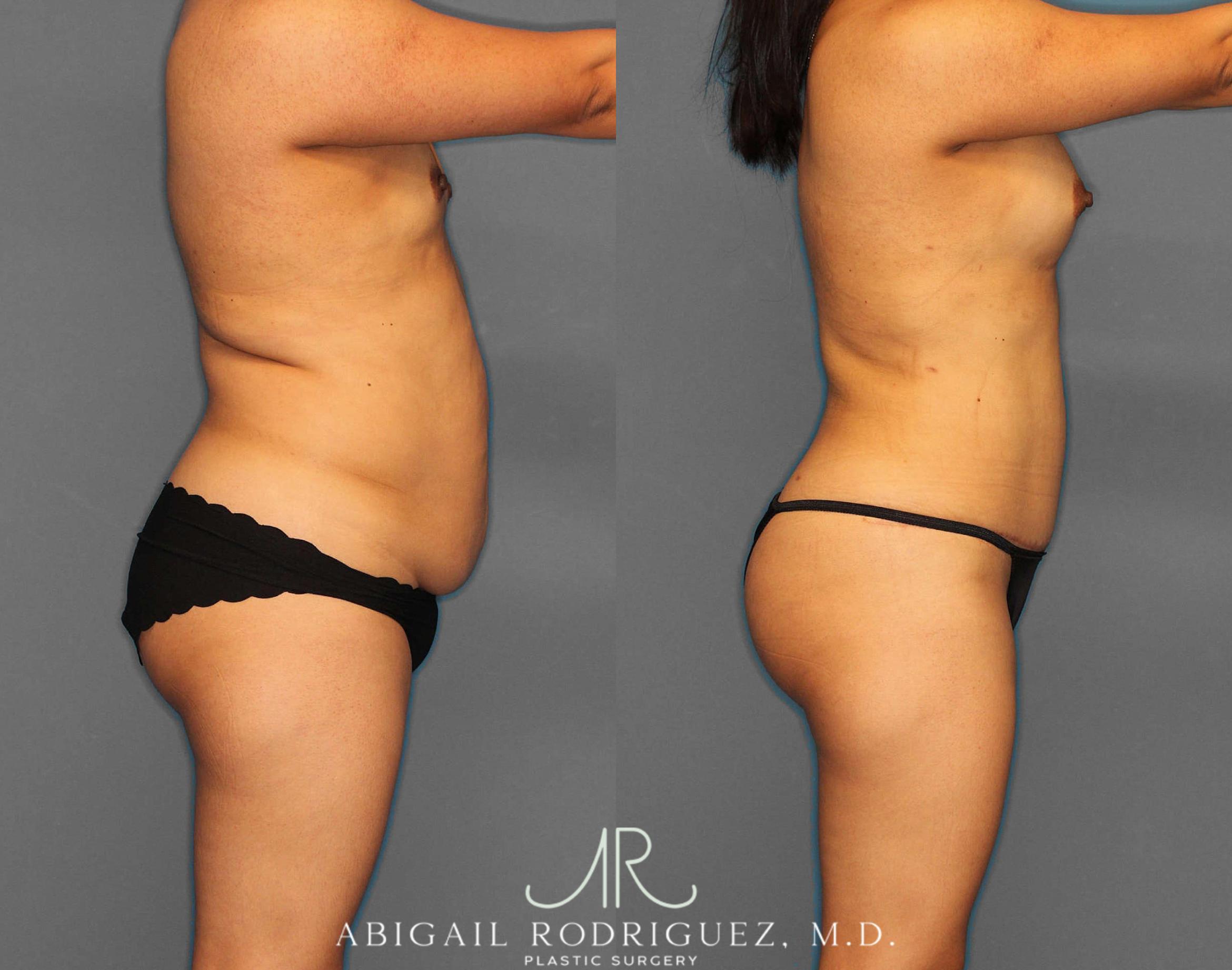 Before & After Mommy Makeover Case 254522 View 2 View in Houston, TX