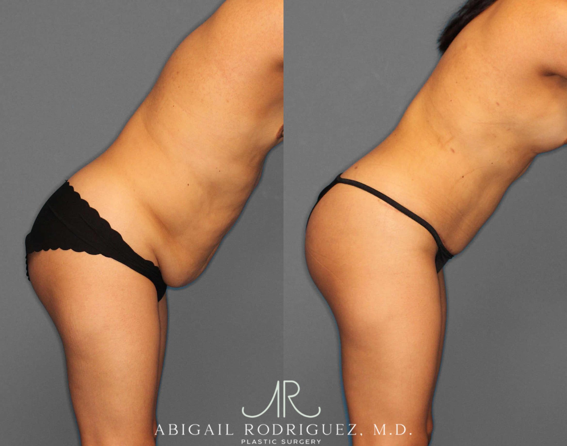 Before & After Mommy Makeover Case 254522 View 3 View in Houston, TX