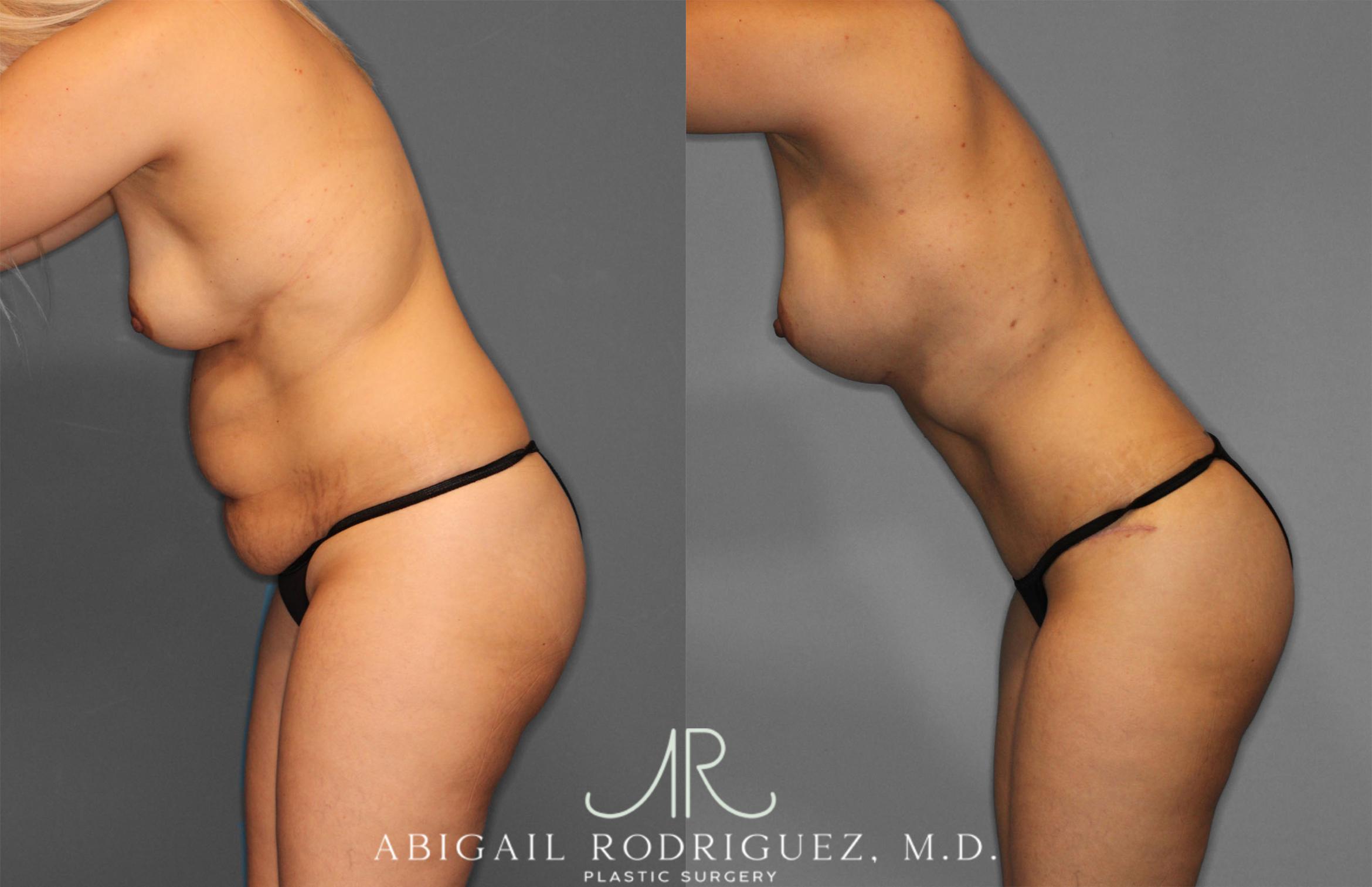 Before & After Mommy Makeover Case 257284 View 4 View in Houston, TX