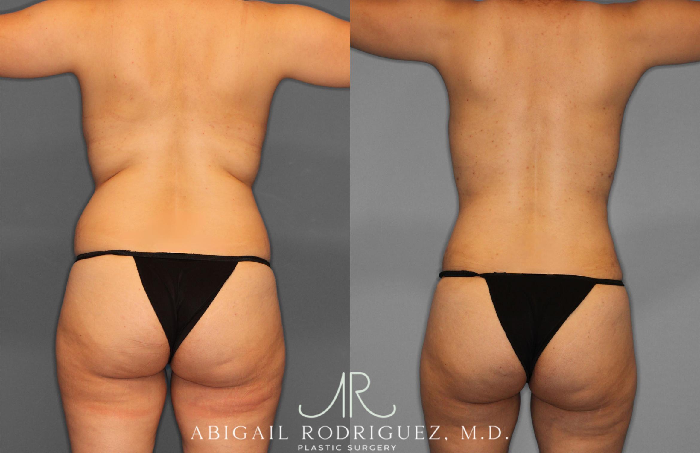 Before & After Mommy Makeover Case 257284 View 6 View in Houston, TX
