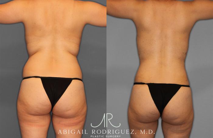 Before & After Mommy Makeover Case 257284 View 6 View in Houston, TX
