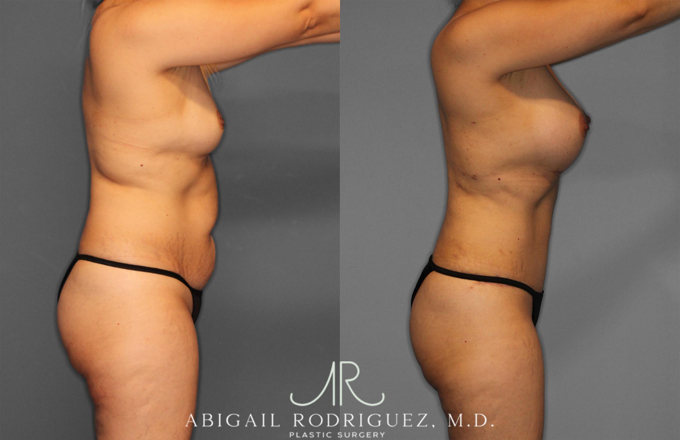 Before & After Mommy Makeover Case 257284 View 8 View in Houston, TX