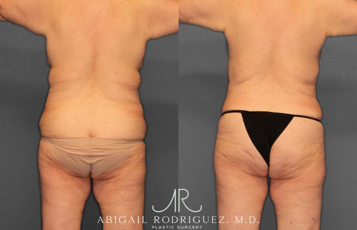 Before & After Mommy Makeover Case 258531 View 6 View in Houston, TX