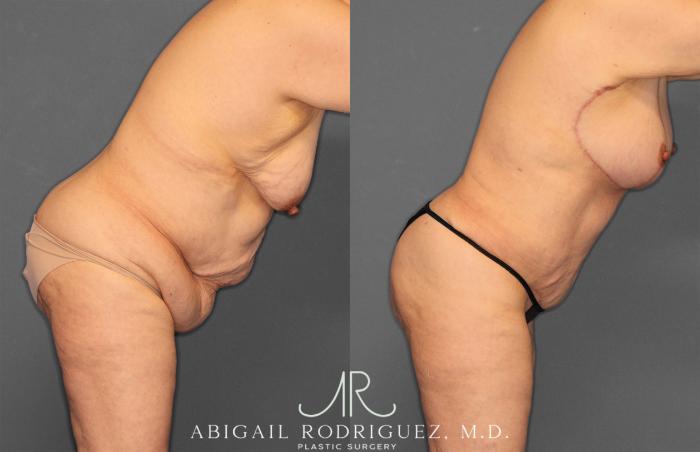 Before & After Mommy Makeover Case 258531 View 9 View in Houston, TX