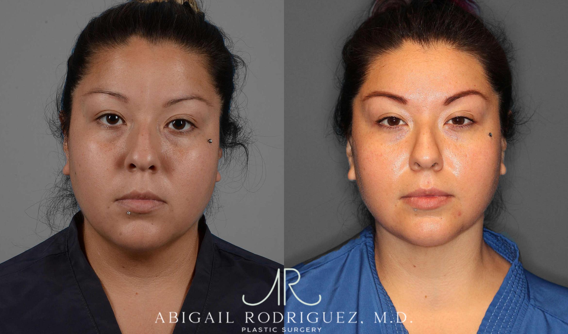 Before & After Neck Liposuction Case 254338 View 1 View in Houston, TX