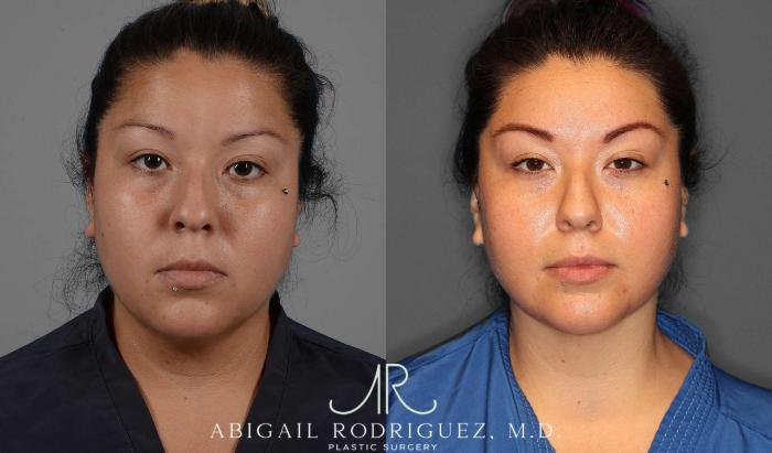 Before & After Neck Liposuction Case 254338 View 1 View in Houston, TX