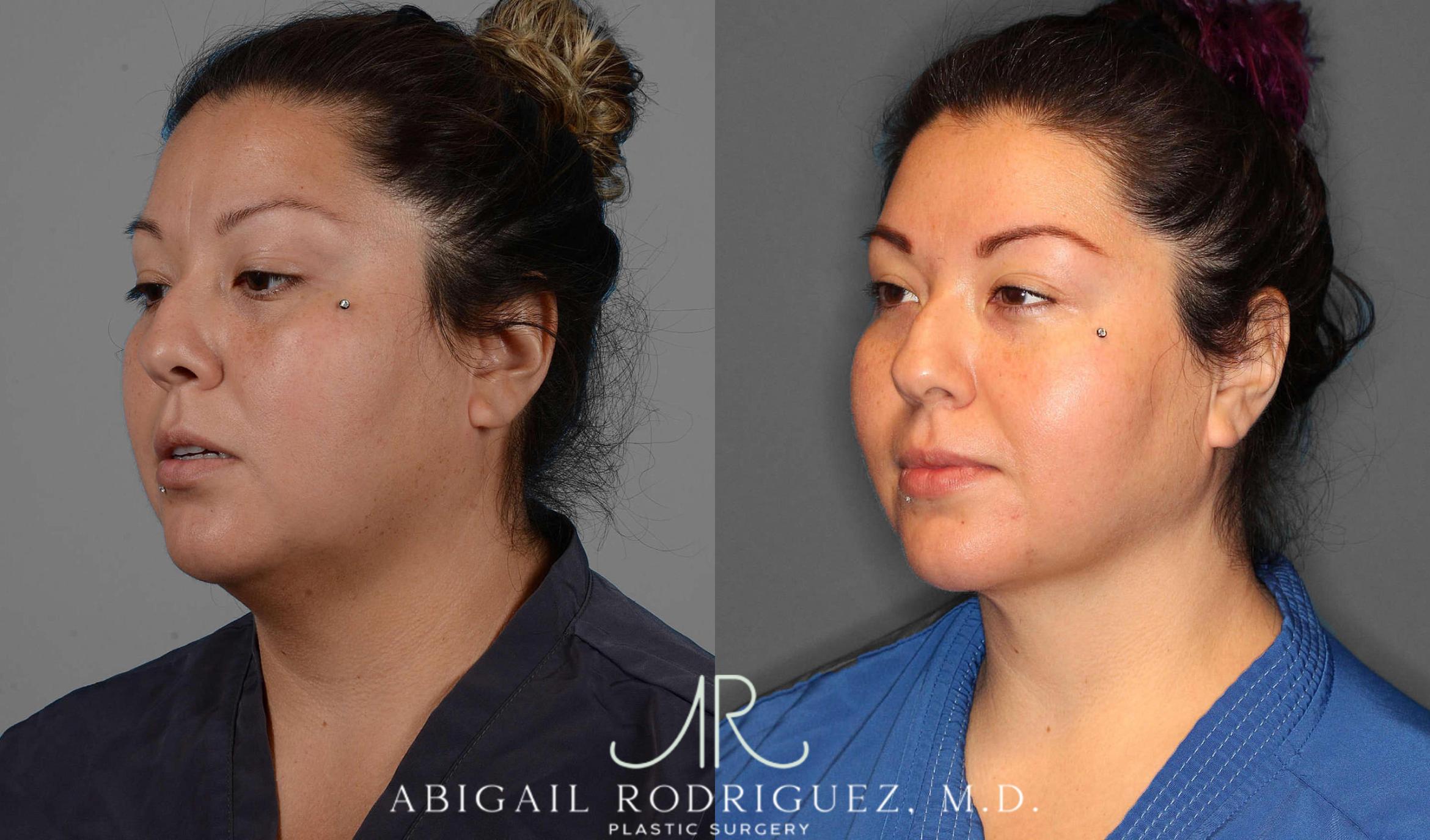 Before & After Neck Liposuction Case 254338 View 2 View in Houston, TX