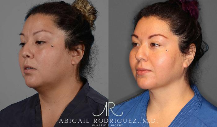 Before & After Neck Liposuction Case 254338 View 2 View in Houston, TX
