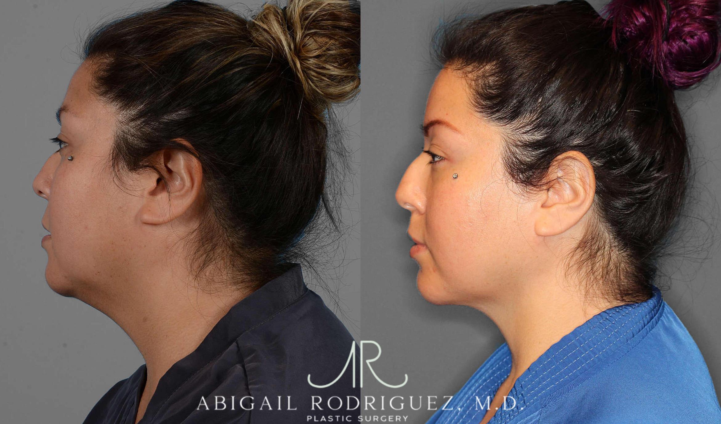 Before & After Neck Liposuction Case 254338 View 3 View in Houston, TX