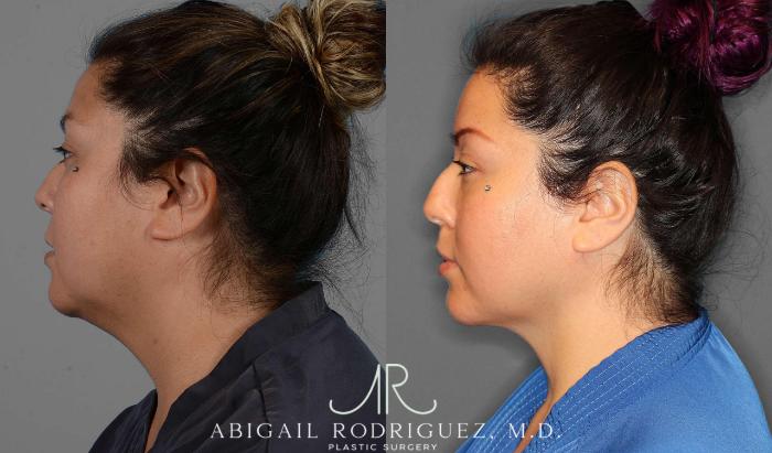 Before & After Neck Liposuction Case 254338 View 3 View in Houston, TX