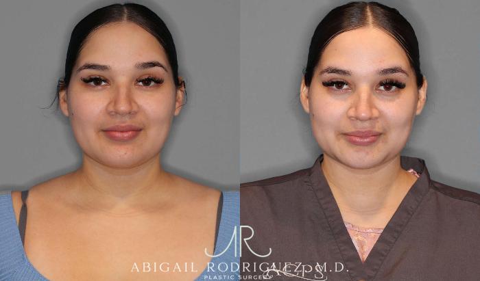 Before & After Neck Liposuction Case 254340 View 1 View in Houston, TX