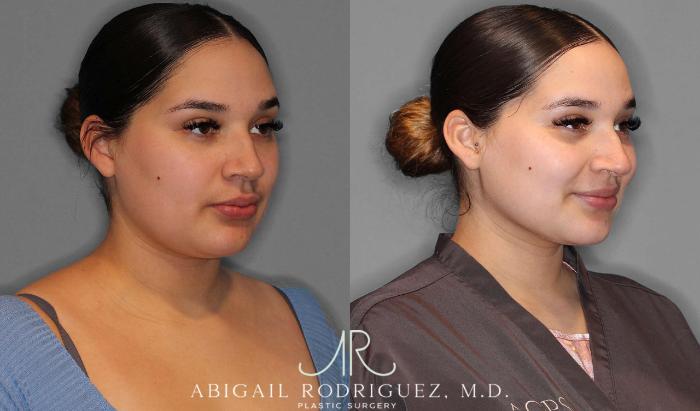 Before & After Neck Liposuction Case 254340 View 2 View in Houston, TX
