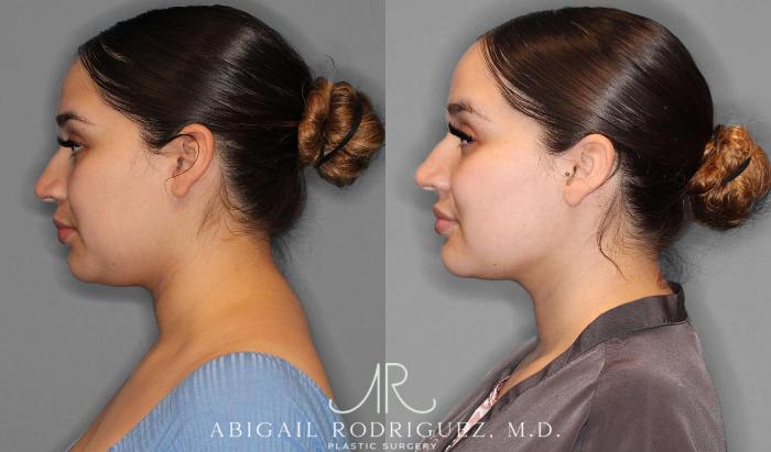 Before & After Neck Liposuction Case 254340 View 3 View in Houston, TX