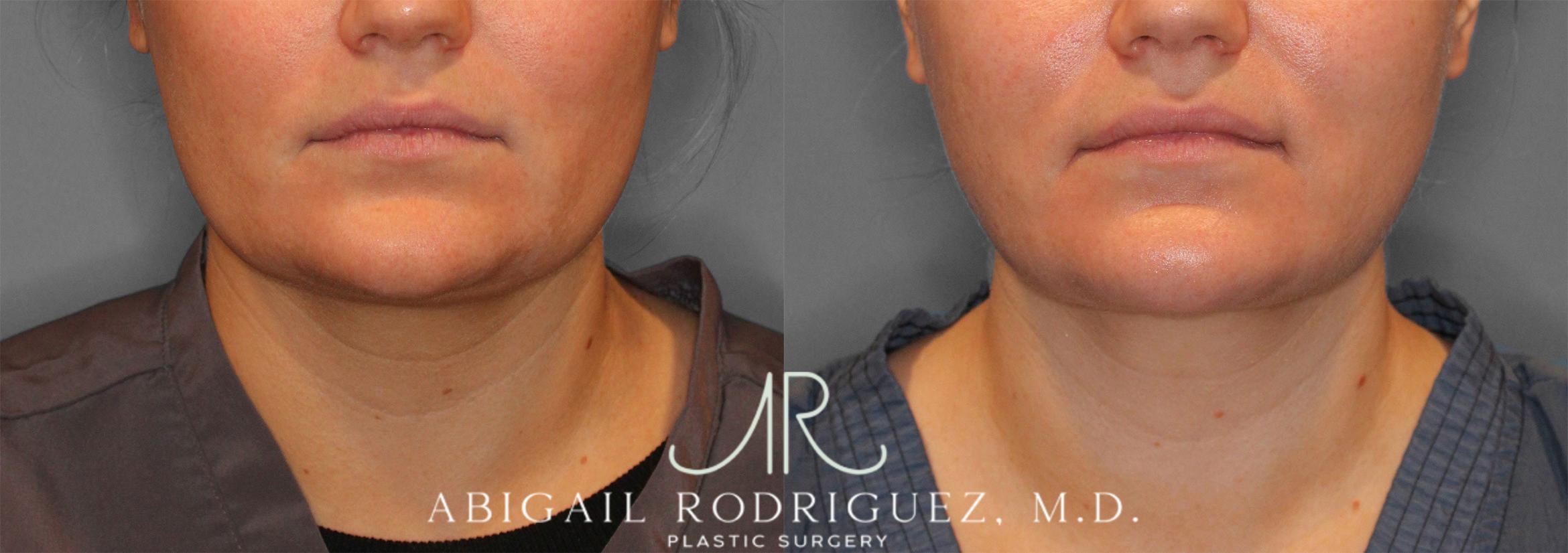Before & After Neck Liposuction Case 258279 View 1 View in Houston, TX