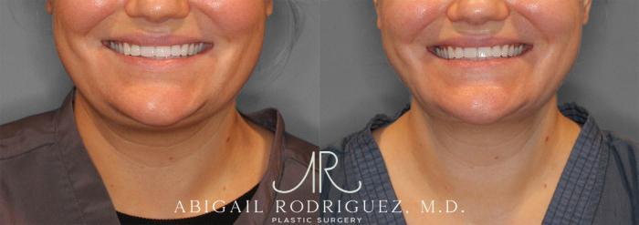 Before & After Neck Liposuction Case 258279 View 2 View in Houston, TX