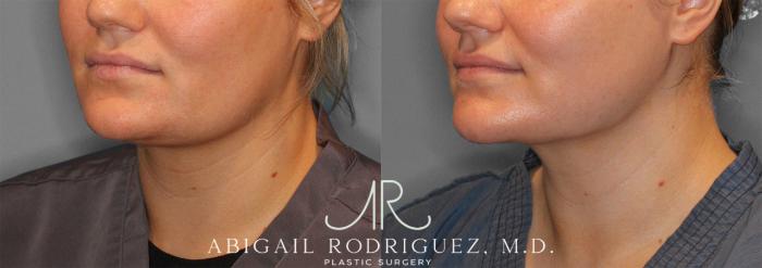 Before & After Neck Liposuction Case 258279 View 3 View in Houston, TX