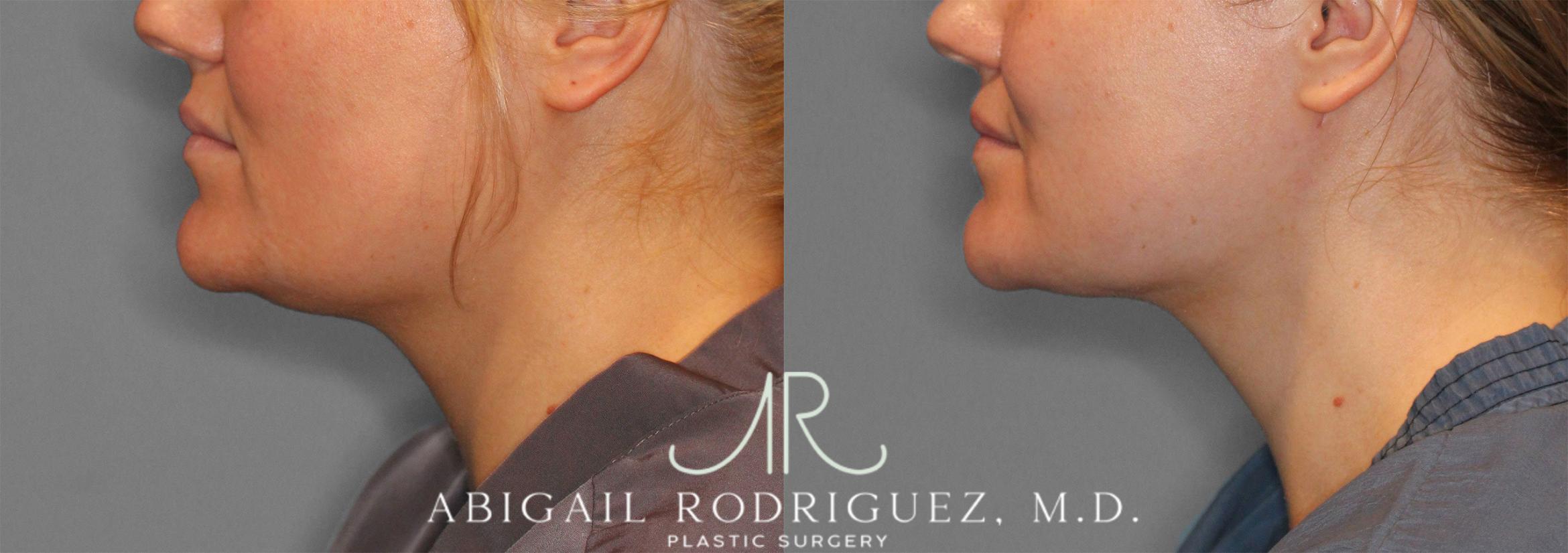 Before & After Neck Liposuction Case 258279 View 4 View in Houston, TX
