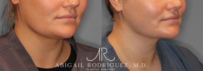 Before & After Neck Liposuction Case 258279 View 5 View in Houston, TX