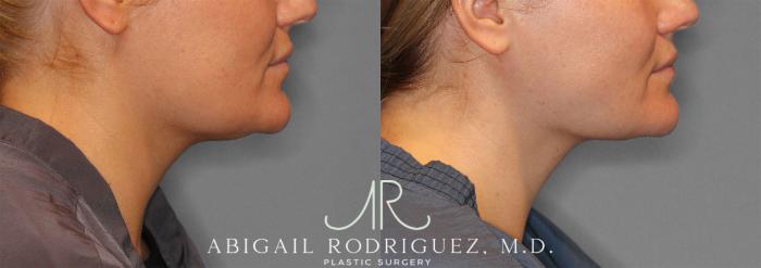 Before & After Neck Liposuction Case 258279 View 6 View in Houston, TX