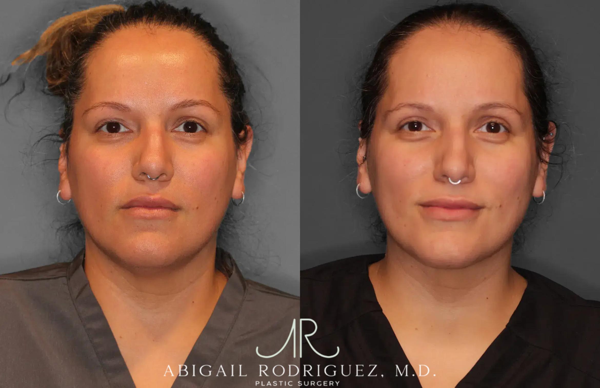 Before & After Neck Liposuction Case 259277 View 1 View in Houston, TX