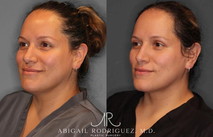 Before & After Neck Liposuction Case 259277 View 2 View in Houston, TX