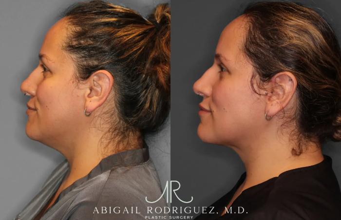 Before & After Neck Liposuction Case 259277 View 3 View in Houston, TX