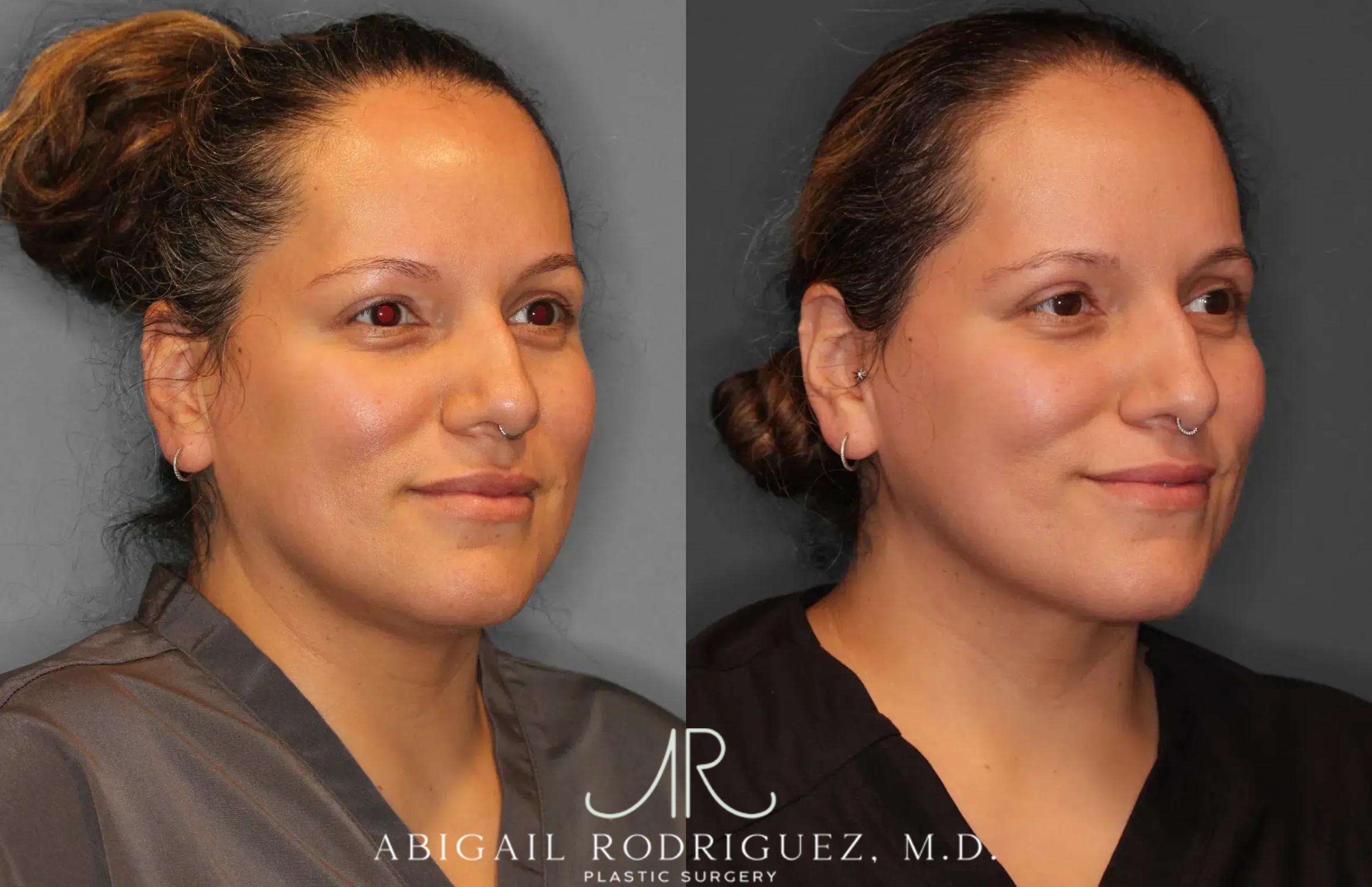 Before & After Neck Liposuction Case 259277 View 4 View in Houston, TX