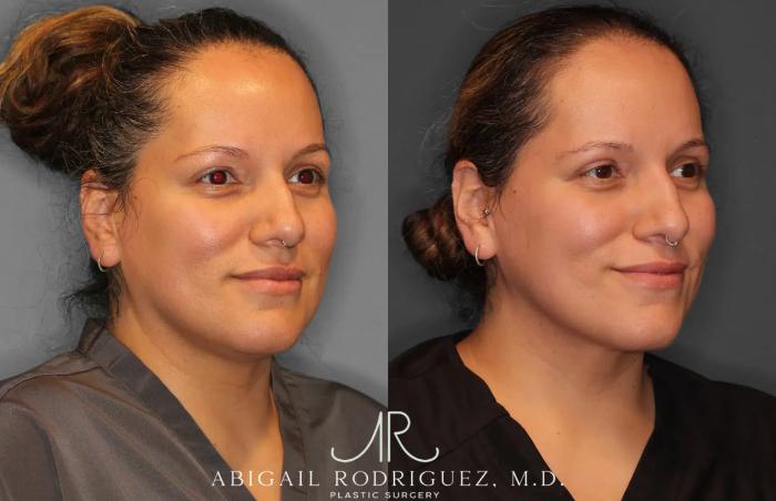 Before & After Neck Liposuction Case 259277 View 4 View in Houston, TX