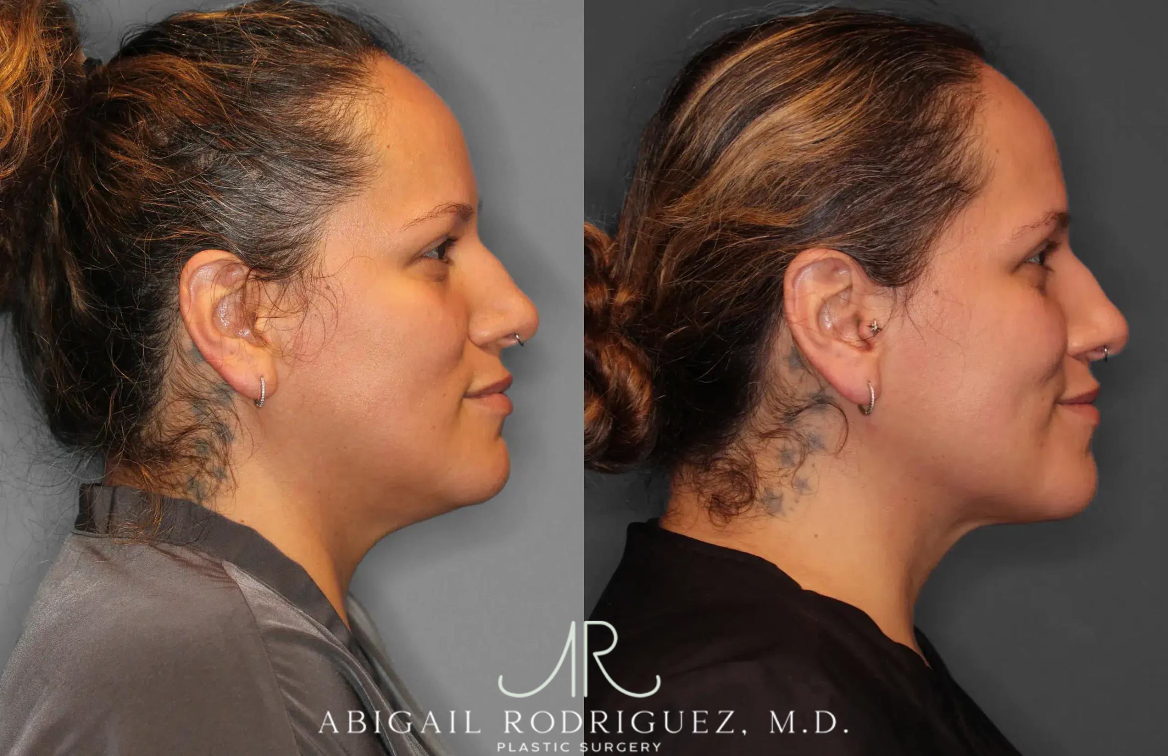 Before & After Neck Liposuction Case 259277 View 5 View in Houston, TX