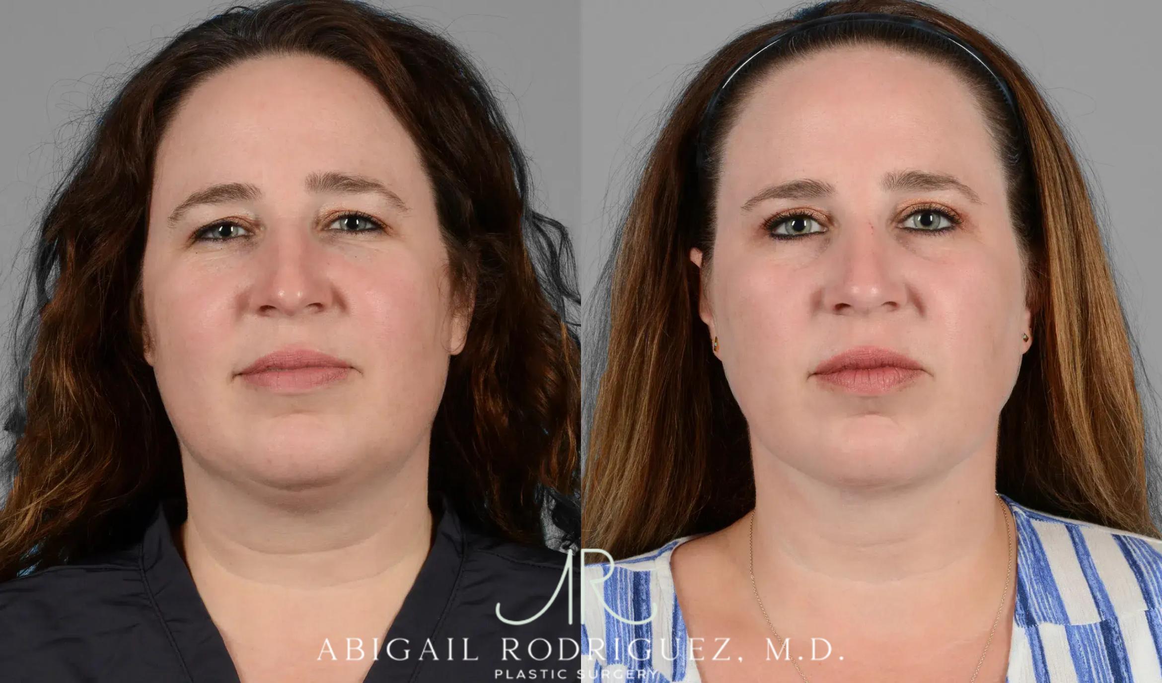 Before & After Neck Liposuction Case 259341 View 1 View in Houston, TX