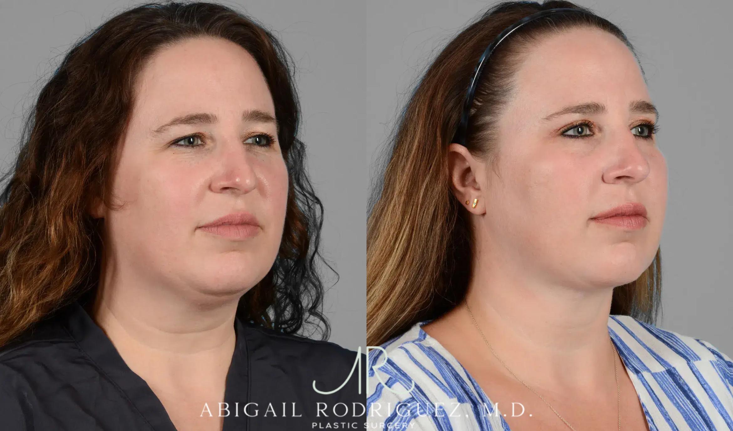 Before & After Neck Liposuction Case 259341 View 2 View in Houston, TX