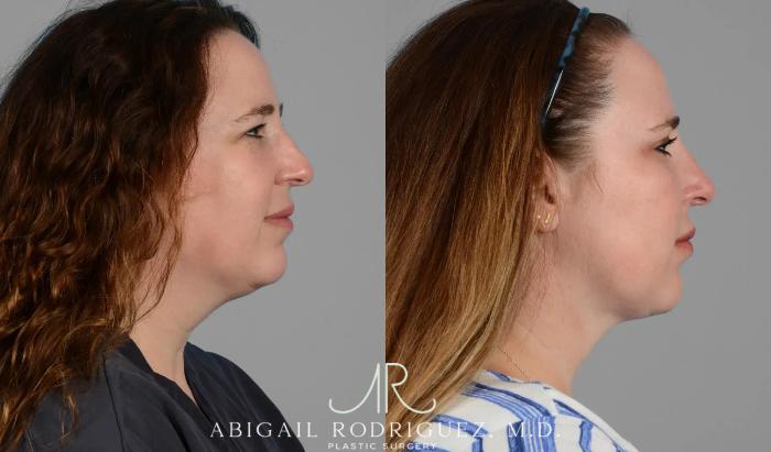 Before & After Neck Liposuction Case 259341 View 3 View in Houston, TX
