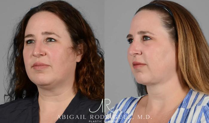 Before & After Neck Liposuction Case 259341 View 4 View in Houston, TX