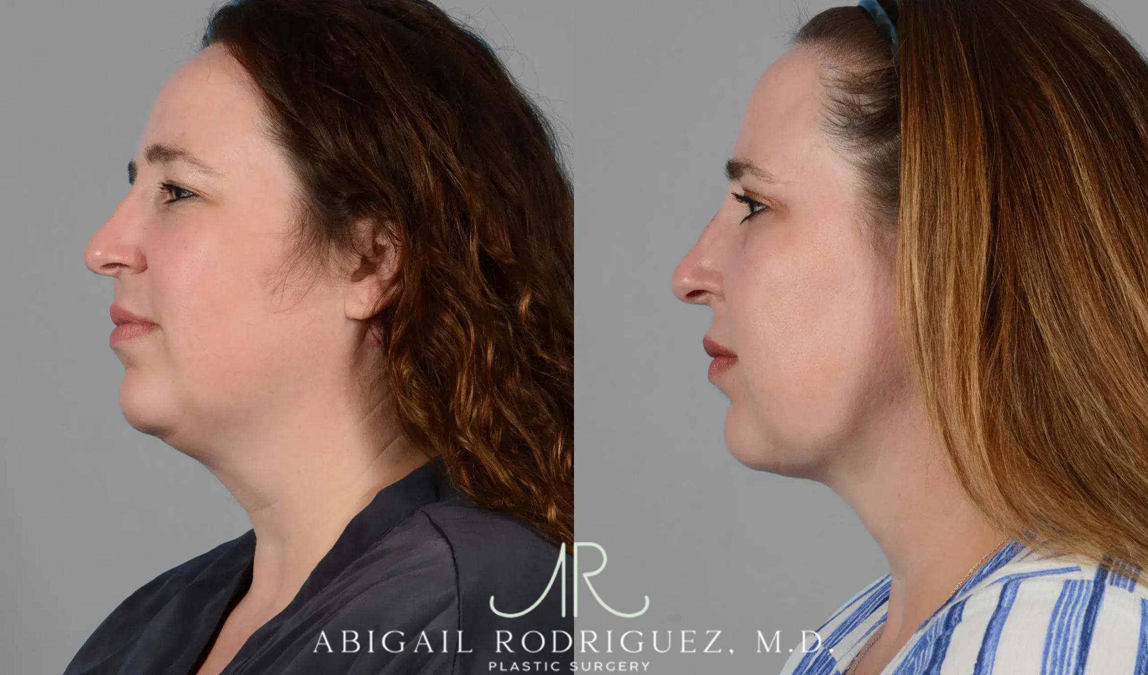 Before & After Neck Liposuction Case 259341 View 5 View in Houston, TX