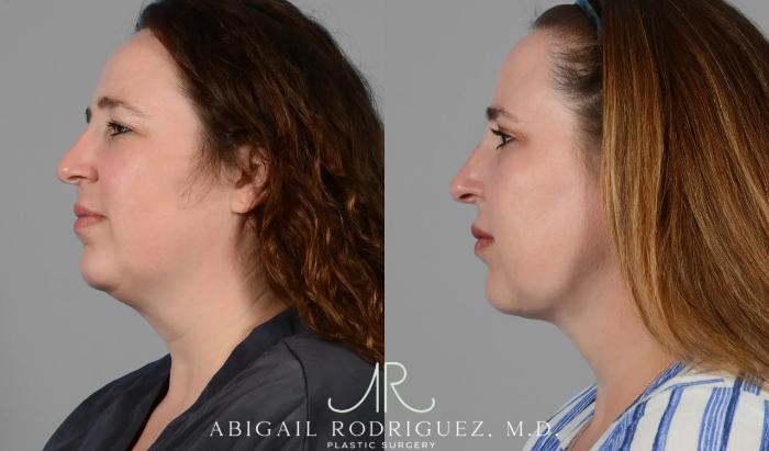 Before & After Neck Liposuction Case 259341 View 5 View in Houston, TX