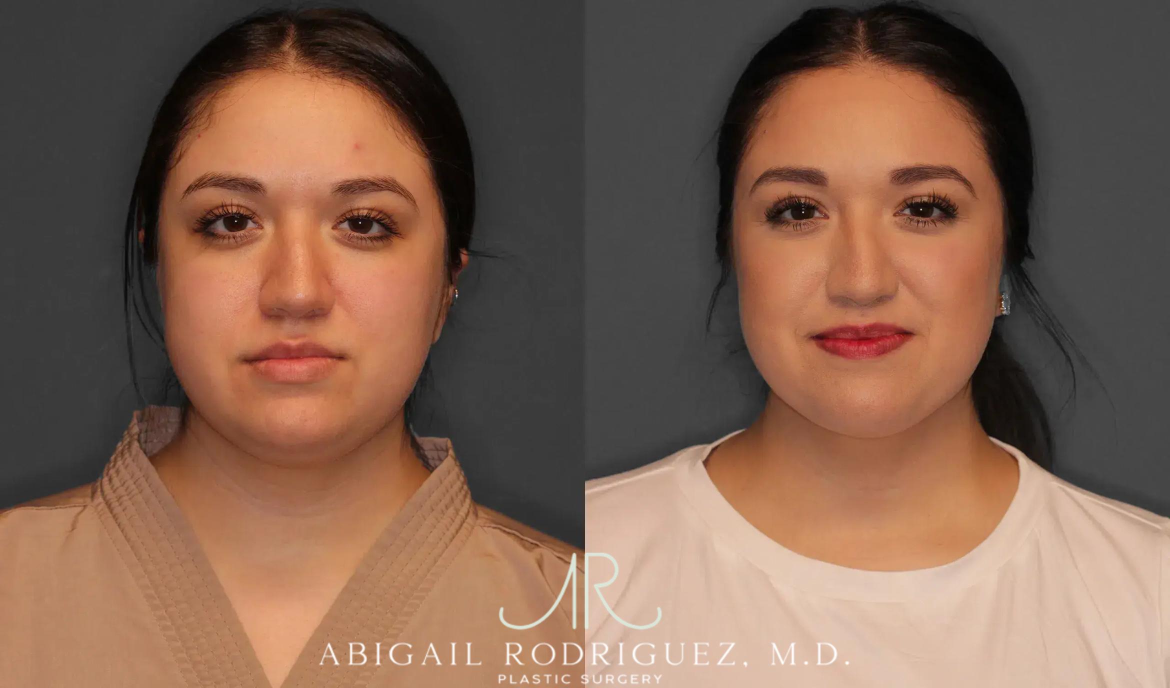 Before & After Neck Liposuction Case 259368 View 1 View in Houston, TX