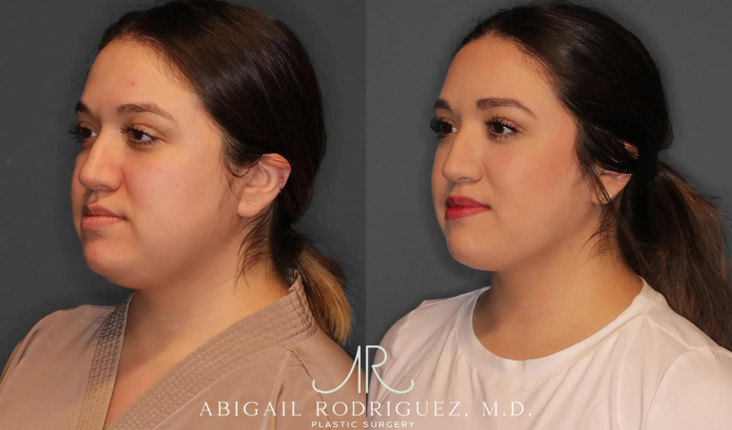 Before & After Neck Liposuction Case 259368 View 2 View in Houston, TX