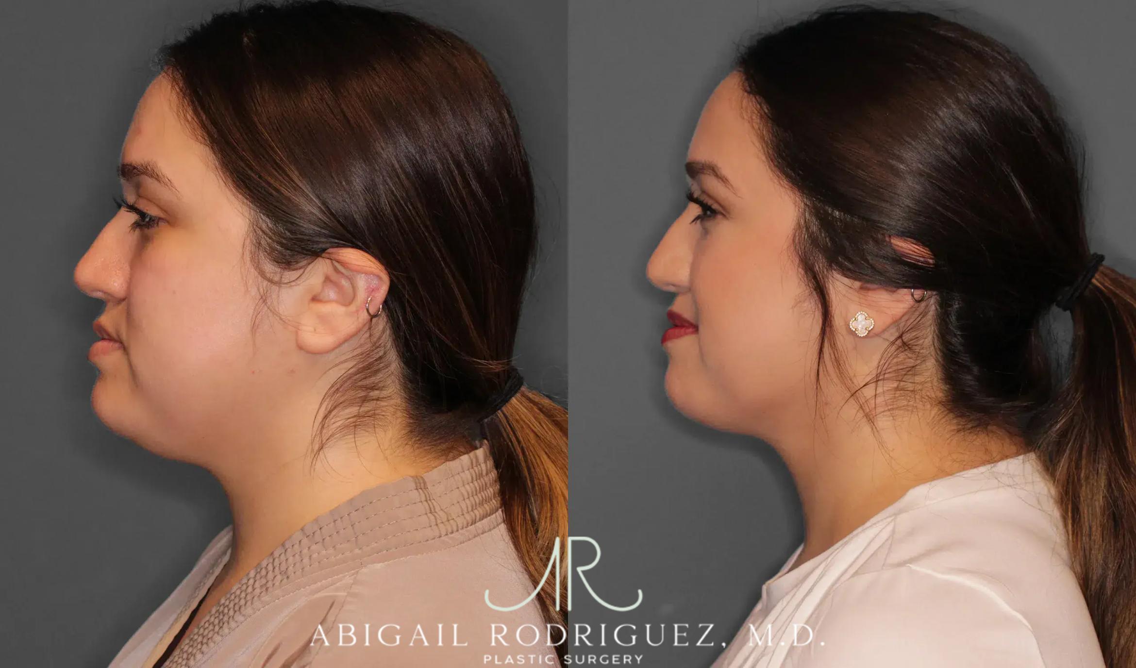Before & After Neck Liposuction Case 259368 View 3 View in Houston, TX