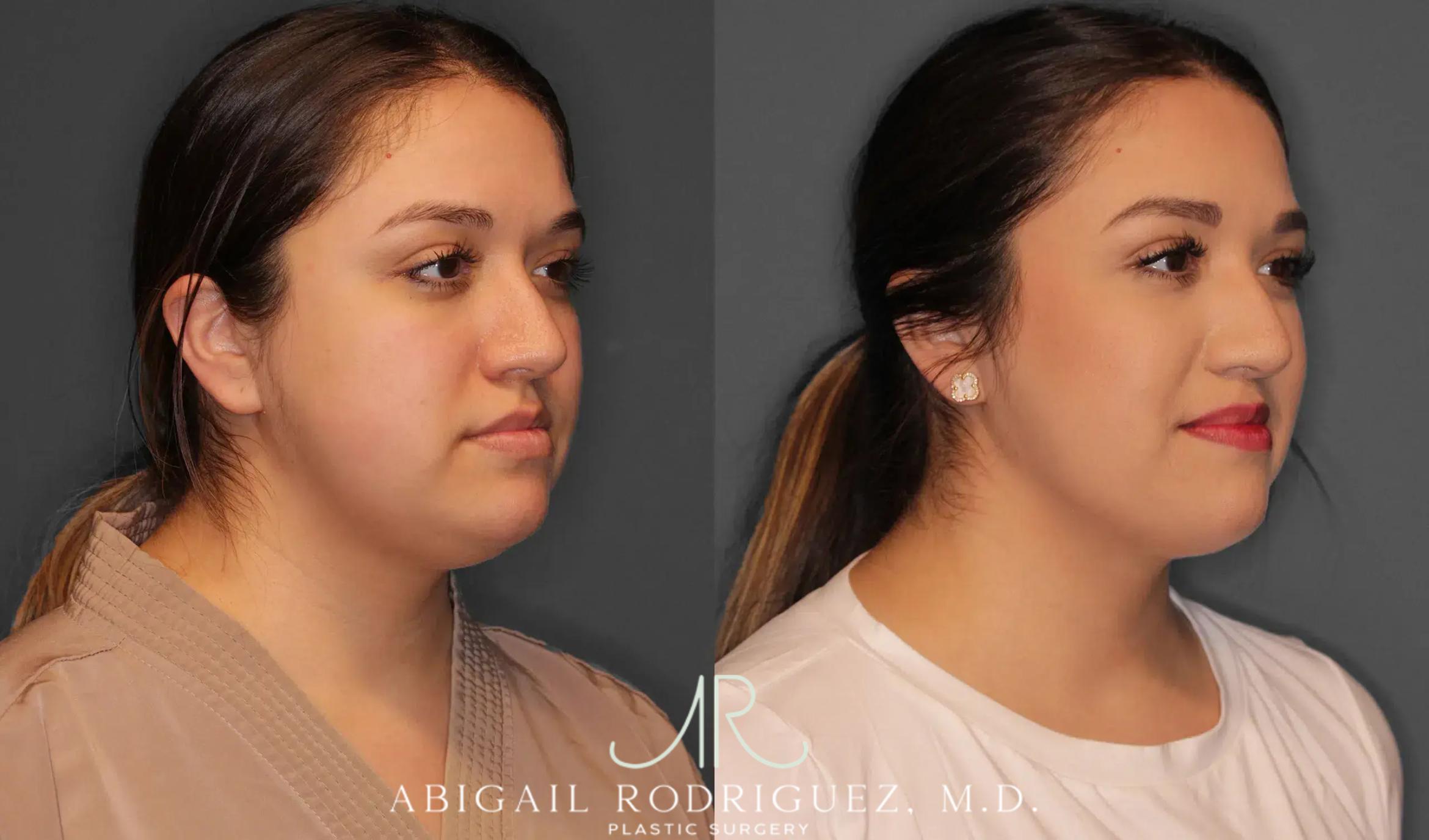 Before & After Neck Liposuction Case 259368 View 4 View in Houston, TX