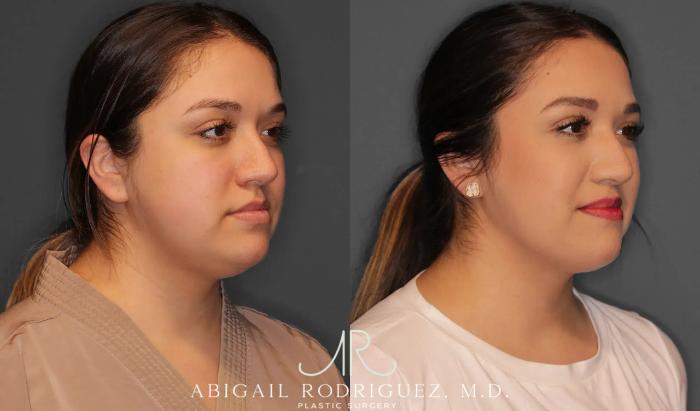 Before & After Neck Liposuction Case 259368 View 4 View in Houston, TX