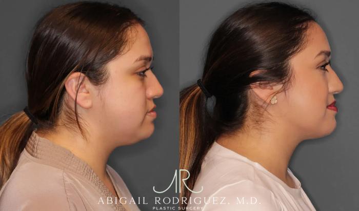 Before & After Neck Liposuction Case 259368 View 5 View in Houston, TX