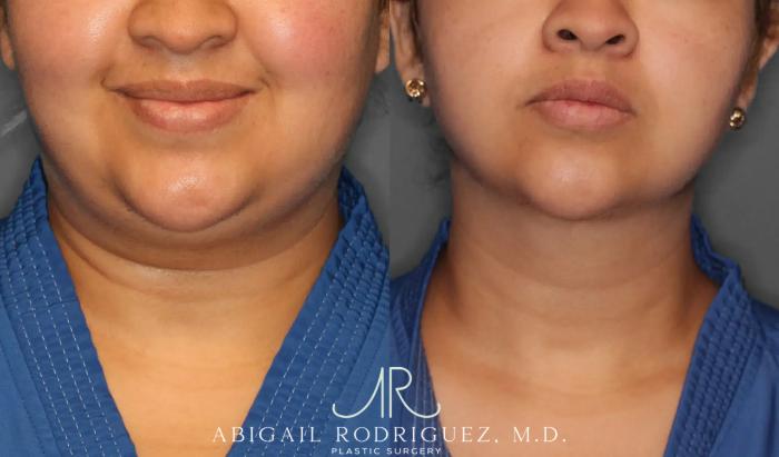 Before & After Neck Liposuction Case 259393 View 1 View in Houston, TX