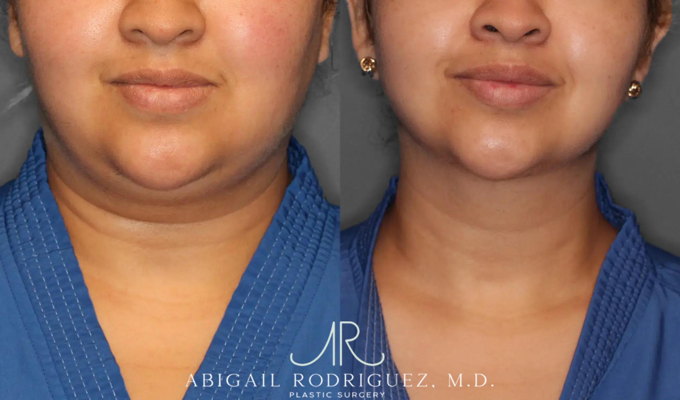 Before & After Neck Liposuction Case 259393 View 2 View in Houston, TX