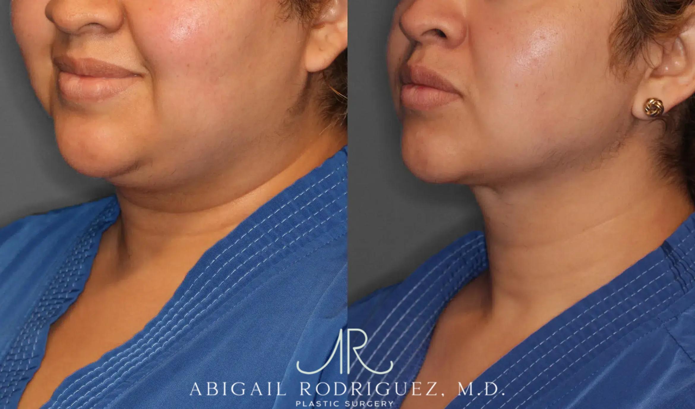 Before & After Neck Liposuction Case 259393 View 3 View in Houston, TX