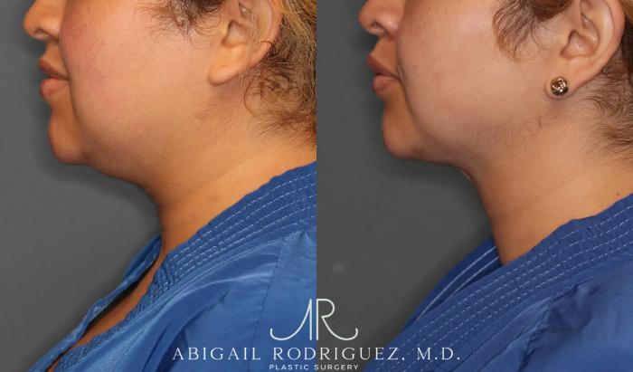 Before & After Neck Liposuction Case 259393 View 4 View in Houston, TX